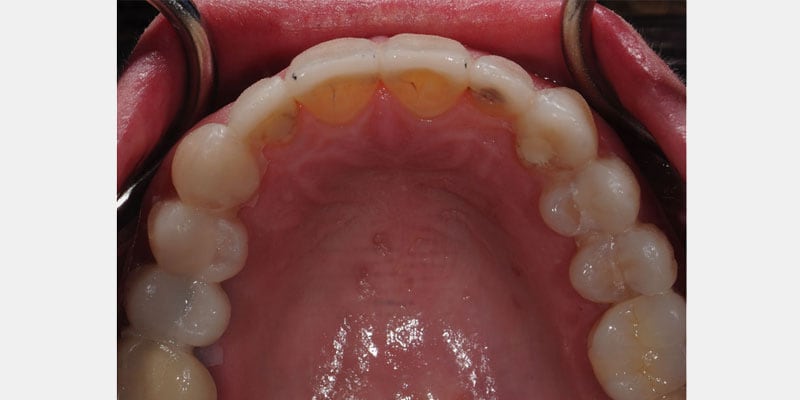 Carillas dentales: cuando el sellado se rompe, el diente queda expuesto a la humedad y a las bacterias